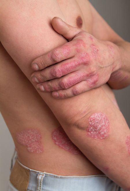 Psoriasis Treatment