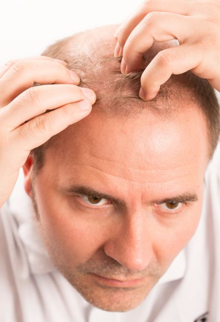 Fue Hair Transplant